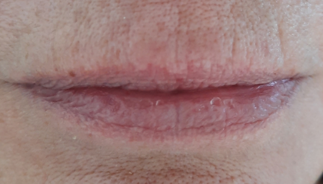 Lippenbehandlung, vorher/nachher
